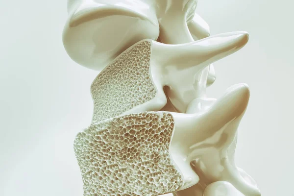 Osteoporosis Columna Vertebral Renderizado —  Fotos de Stock