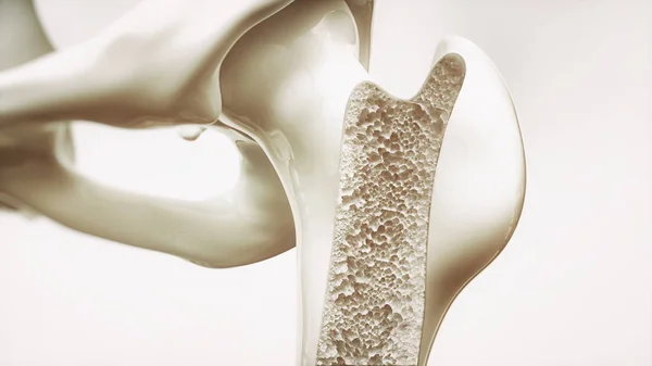 Osteoporose Fase Van Bovenste Extremiteit Botten — Stockfoto