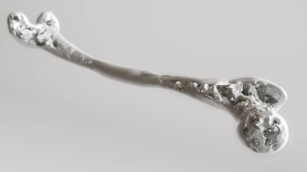 Стадия остеопороза 4 из 4 - кости верхней конечности
