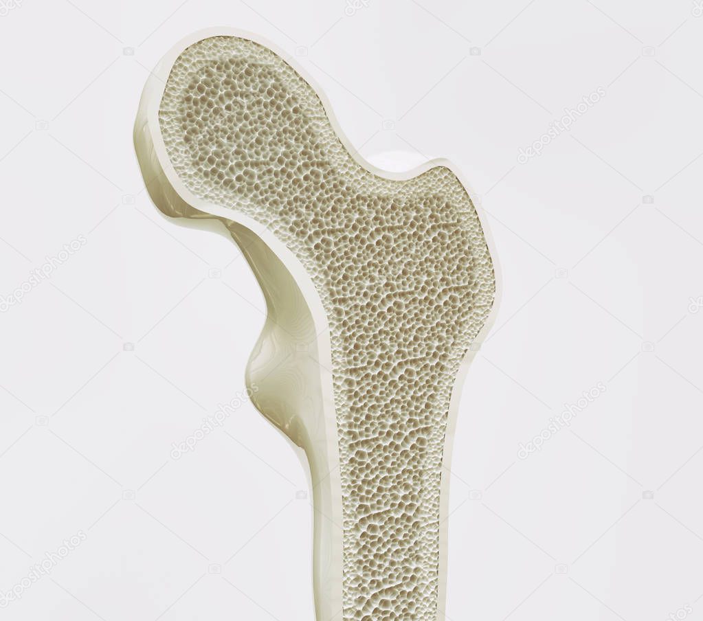 Osteoporosis stage 1 of 4 - 3d rendering