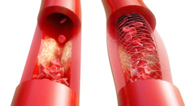 Atherosclerosis ve beyaz arka plandaki tedavileri