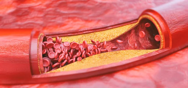 Closeup Atherosclerosis Rendering — Stock Photo, Image