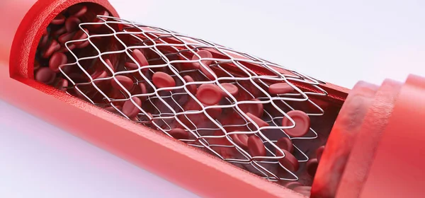 Angioplastia Con Colocación Stent Renderizado — Foto de Stock