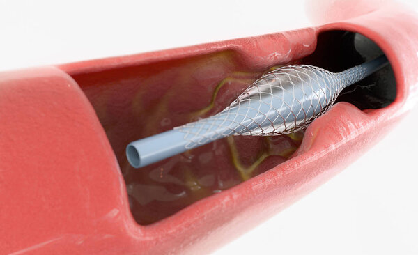 atherosclerosis treatment with stent insert -- 3D Rendering