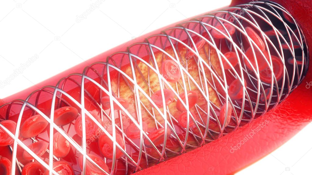 Angioplasty with stent placement on white background