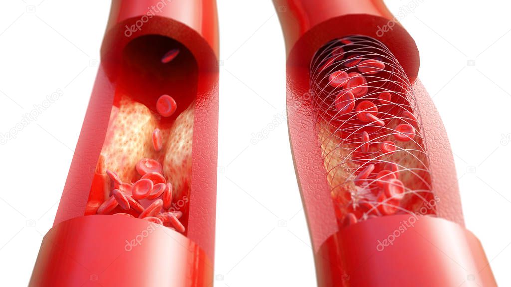 atherosclerosis and their treatment on white background