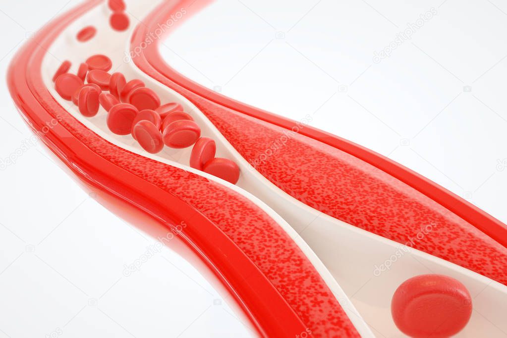 atherosclerosis and their treatment on white background