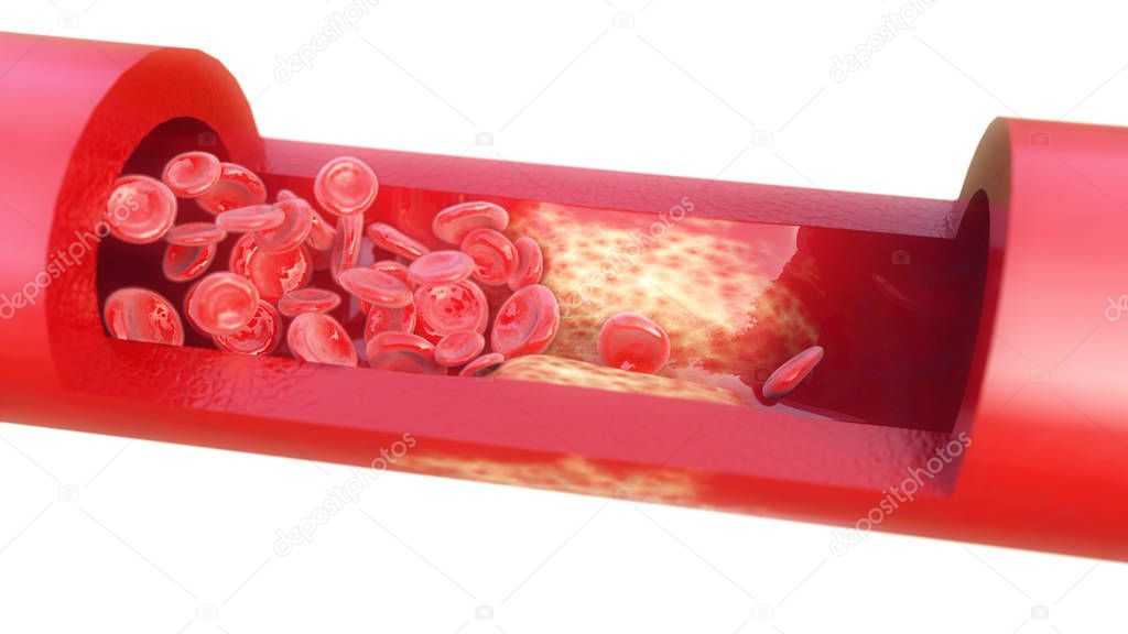 Closeup of a atherosclerosis on white background