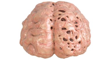 Şiddetli beyin hastalıkları, Bunama, Alzheimer, Korea Huntington -- 3D Rendering