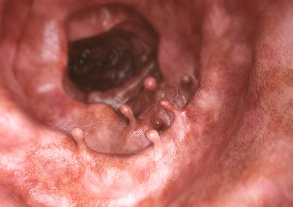 Bağırsak polip closeup--3d render