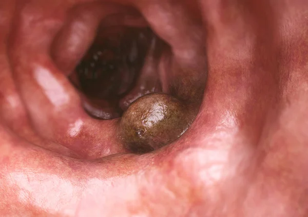 Primer Plano Del Cáncer Colon Renderizado — Foto de Stock