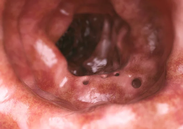 Diverticula 렌더링 — 스톡 사진