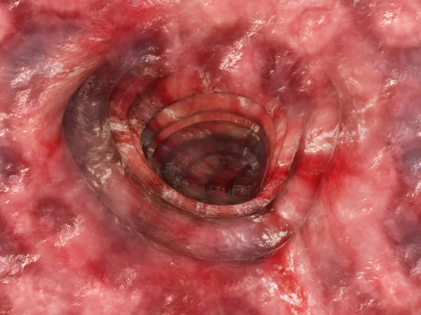 Colitis Ulcerosa Tahap Rendering — Stok Foto