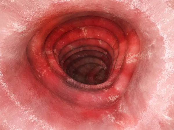 Colite Ulcerosa Fase Renderização — Fotografia de Stock