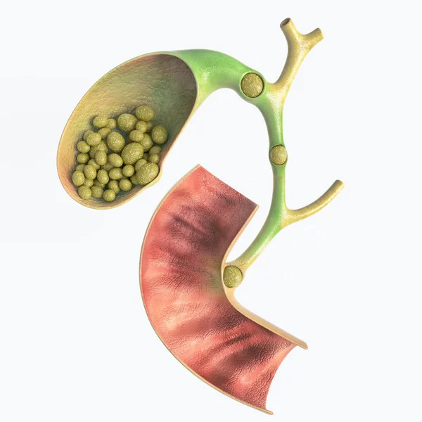 Gallstones Gallbladder Bile Duct High Details Rendering — Stock Photo, Image