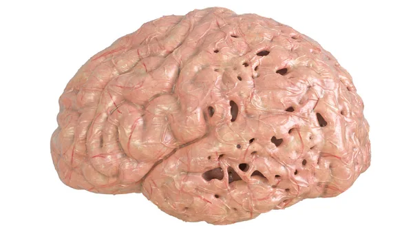 Εγκέφαλος Σοβαρή Εγκεφαλική Νόσο Άνοια Αλτσχάιμερ Χορέα Χάντινγκτον Αποτύπωση — Φωτογραφία Αρχείου