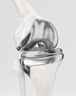 Diz protezi -- 3D görüntüleme