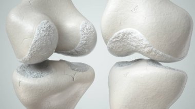 Diz eklemi, Arthem yüzünden kıkırdak kaybı, ön ve arka... 3 boyutlu görüntüleme