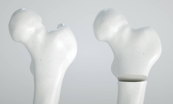 Перелом шейки бедра - 3D рендеринг