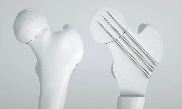 ねじ処理付き大腿骨首の骨折 3Dレンダリング — ストック写真
