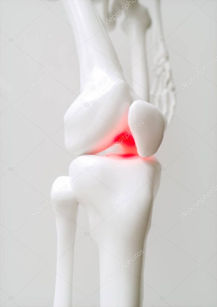 Osteoarthritis-covered knee --- 3D Rendering