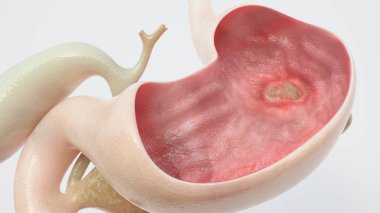Stomach ulcer - high degree of detail -- 3D Rendering clipart