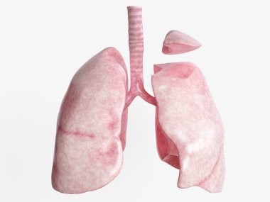 Segmental resection after severe lung disease - 2 of 4 - 3D Rendering clipart