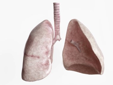 Pneumonectomy after severe lung disease - 4 of 4 - 3D Rendering clipart