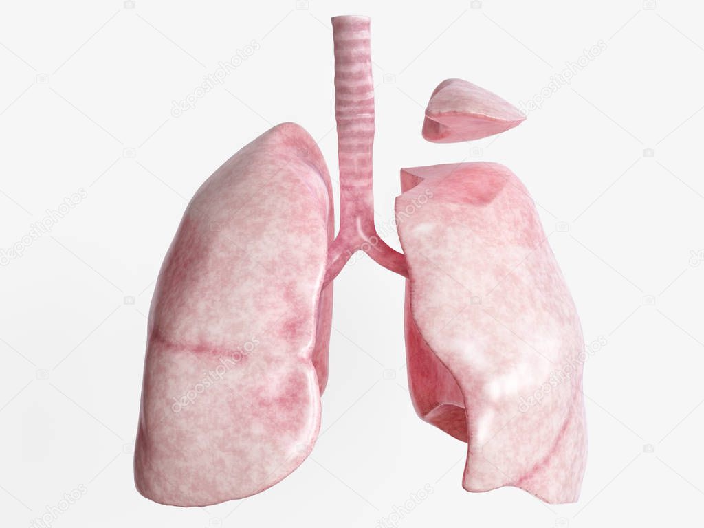 Segmental resection after severe lung disease - 2 of 4 - 3D Rendering