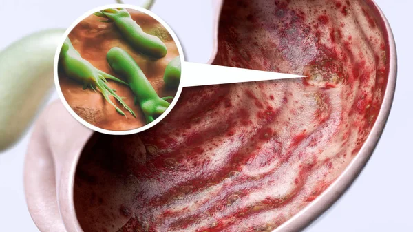 Wrzód Żołądka Przez Helicobacter Pylori Wysoki Stopień Szczegółowości Renderowania — Zdjęcie stockowe