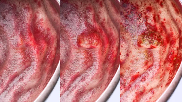 Gastrik ülser çeşitli aşamalarında--yüksek düzeyde ayrıntı--3d render