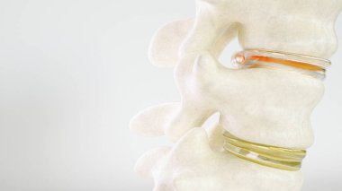 3d Rendering kadar yakın çekim olarak spinal disk hernisi