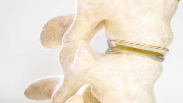 Hernia discal espinal tan cerca como renderización 3D —  Fotos de Stock