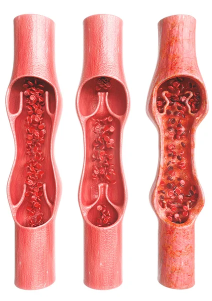 Veias varicosas em comparação com veias saudáveis - 3D Rendering — Fotografia de Stock