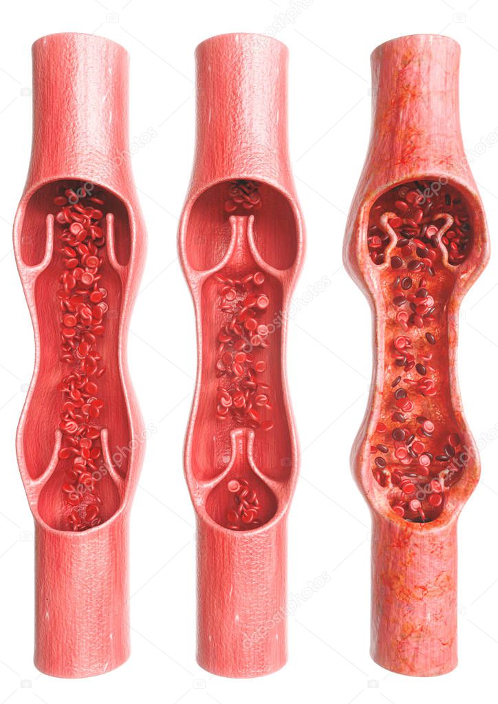 Varicose veins in comparison with healthy veins - 3D Rendering