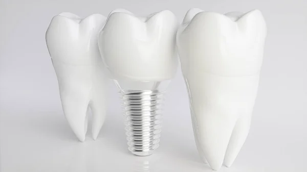 Sağlıklı dişlere göre bir implant - 3d render