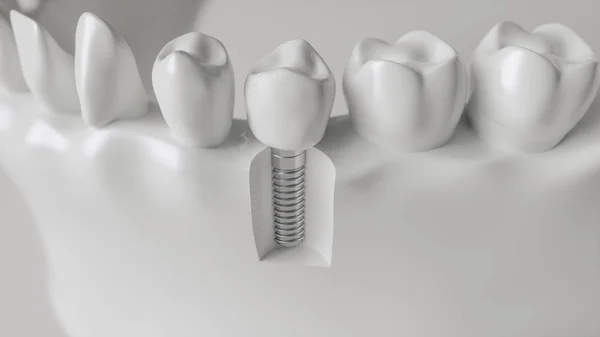 Een implantaat in de jaw-3D rendering — Stockfoto