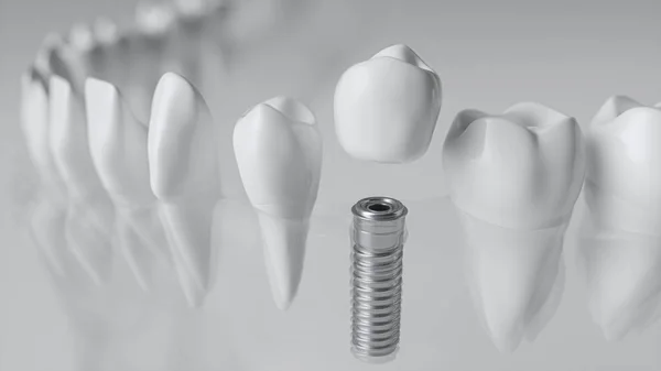 Un implante en una mandíbula vidriosa - 3D Rendering — Foto de Stock