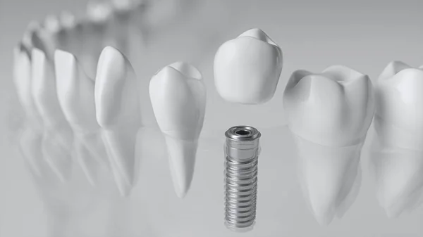 Camsı bir çenebir implant - 3d Rendering