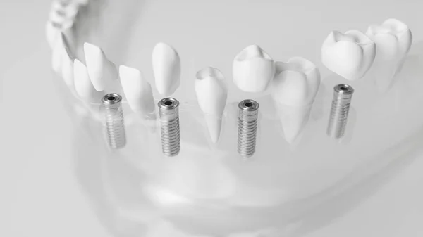 Camsı bir çenede çeşitli implantlar - 3d render