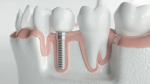 Gezonde tanden en een implantaat - 3d rendering — Stockfoto