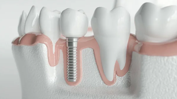 Dientes sanos y un implante - 3D renderizado — Foto de Stock