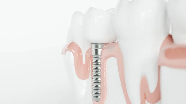 Dientes sanos y un implante - 3D renderizado — Foto de Stock