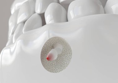 Apikektomi ile kök ucu iltihabı - 3d render