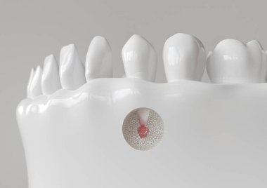 Apikektomi ile kök ucu iltihabı - 3d render