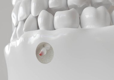 Apikektomi ile kök ucu iltihabı - 3d render