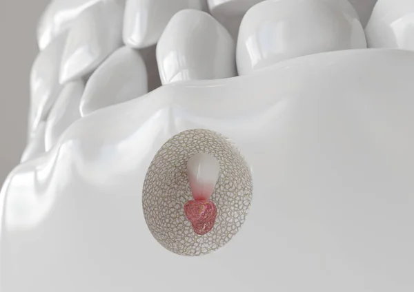 Apikektomi ile kök ucu iltihabı - 3d render