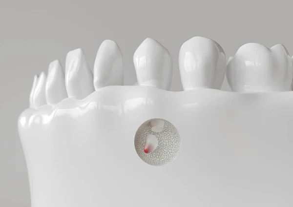 Inflamación de la punta de la raíz con apicectomía - renderizado 3D — Foto de Stock