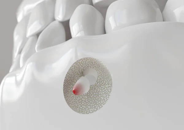 Apikektomi ile kök ucu iltihabı - 3d render