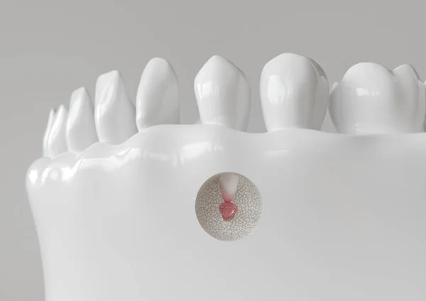 Inflamação da ponta radicular com apicectomia - renderização 3D — Fotografia de Stock
